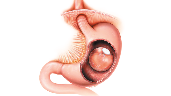Procedura con palloncini intragastrici